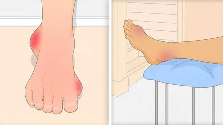 This simple method reveals 5 hidden signs of gout and how to treat them…
