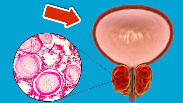 6 Foods You Must Eat for a Healthy Prostate – Discover the Benefits Now!