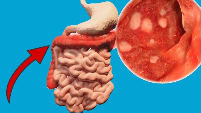 Avoid These 4 Foods for Stomach Ulcers: Your Health Depends on It!