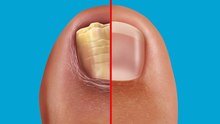 5 Fast Home Remedies to Cure Nail Fungus Naturally and Effectively!