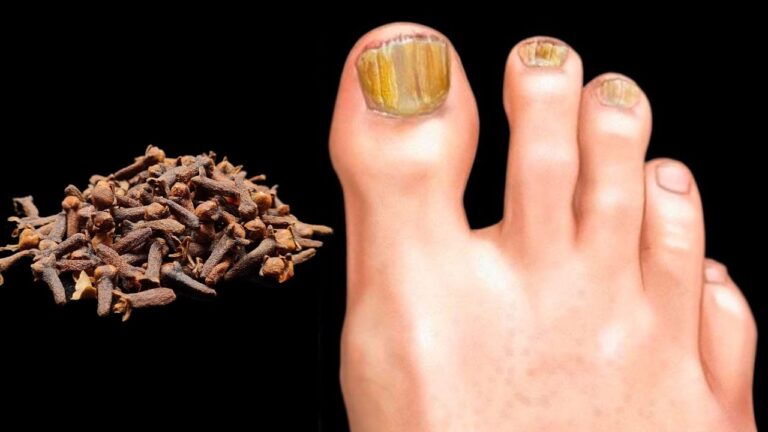 Erase Nail Fungus Instantly: 7 Proven Remedies That Work Like a Charm!