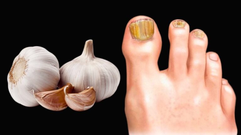 Eliminate Toenail Fungus Fast: 5 Essential Benefits of Garlic You Need to Know!